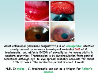 Adult chlamydial (inclusion) conjunctivitis is an oculogenital infection
usually caused by serovars (serological variants) D-K of C.
trachomatis, and affects 5–20% of sexually active young adults in
western countries. Transmission is by autoinoculation from genital
secretions although eye-to-eye spread probably accounts for about
10% of cases. The incubation period is about 1 week.
N.B. In males , C. trachomatis can act as a trigger for Reiter's
disease.
 