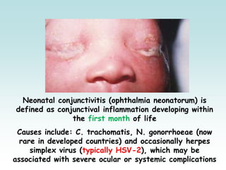 Neonatal conjunctivitis (ophthalmia neonatorum) is
defined as conjunctival inflammation developing within
the first month of life
Causes include: C. trachomatis, N. gonorrhoeae (now
rare in developed countries) and occasionally herpes
simplex virus (typically HSV-2), which may be
associated with severe ocular or systemic complications
 