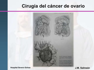 Hospital Severo Ochoa J.M. Salmeán
Cirugía del cáncer de ovario
 
