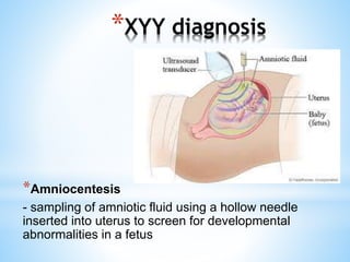 *XYY diagnosis
*Amniocentesis
- sampling of amniotic fluid using a hollow needle
inserted into uterus to screen for developmental
abnormalities in a fetus
 