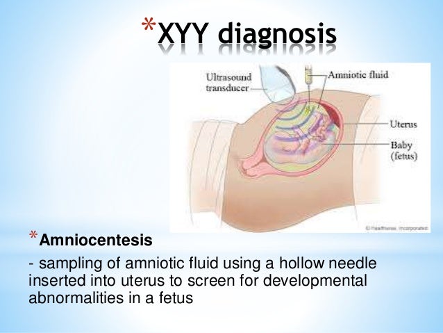 Xyy A Genetic Disorder Xyy A Genetic Disorder