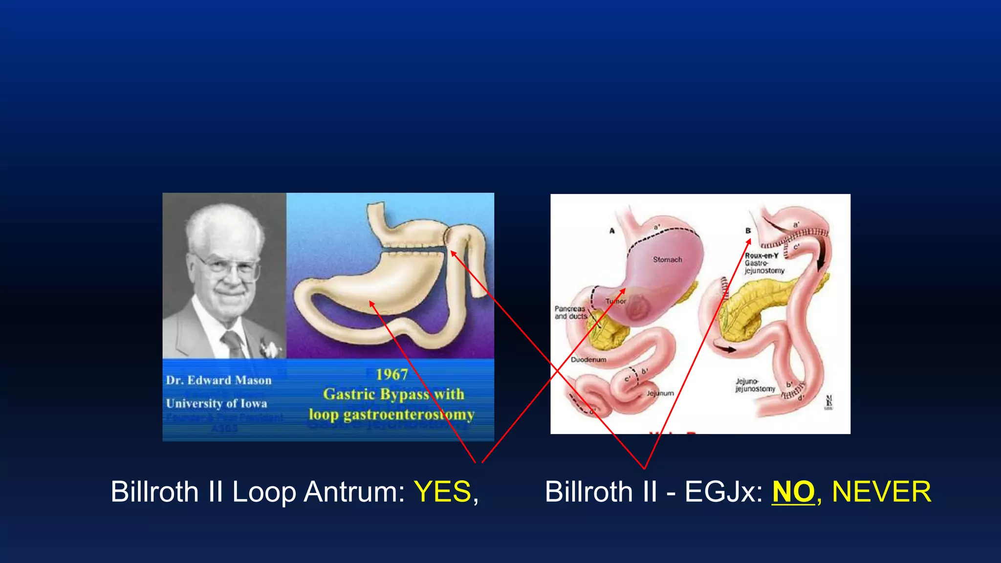 Dr Rutledge Introduction & Background Mini-Gastric Bypass | PPTX