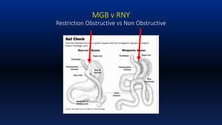 Dr Rutledge Introduction & Background Mini-Gastric Bypass | PPTX