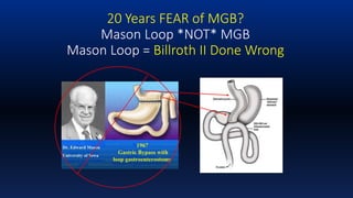Dr Rutledge Introduction & Background Mini-Gastric Bypass | PPTX