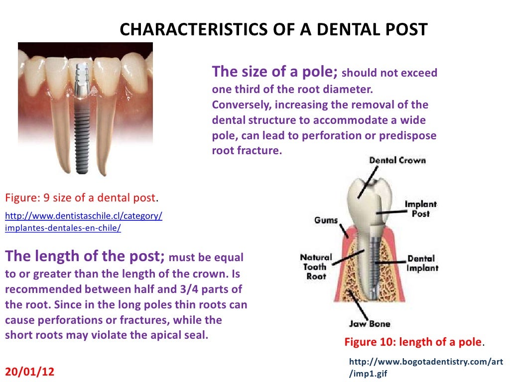 DENTAL POST