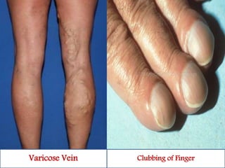 Varicose Vein Clubbing of Finger 
 