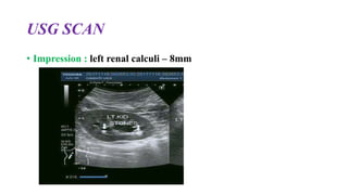 USG SCAN
• Impression : left renal calculi – 8mm
 