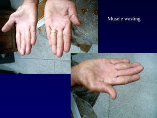 Muscle wasting
 