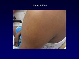 Fasciculations
 