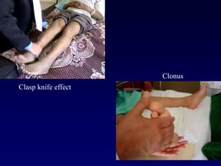 Clasp knife effect
Clonus
 