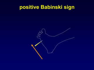 positive Babinski sign
 