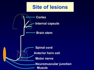 Site of lesions
Cortex
Internal capsule
Brain stem
Spinal cord
Anterior horn cell
Motor nerve
Neuromuscular junction
Muscle
 