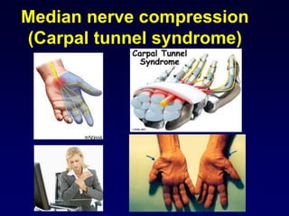 Median nerve compression
(Carpal tunnel syndrome)
 