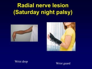Radial nerve lesion
(Saturday night palsy)
Wrist drop
Wrist guard
 