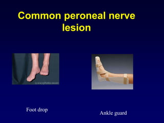 Common peroneal nerve
lesion
Foot drop
Ankle guard
 