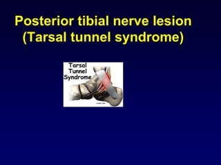 Posterior tibial nerve lesion
(Tarsal tunnel syndrome)
 