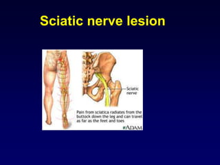 Sciatic nerve lesion
 