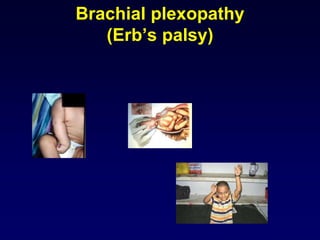 Brachial plexopathy
(Erb’s palsy)
 