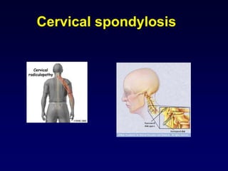Cervical spondylosis
 