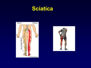 Sciatica
 