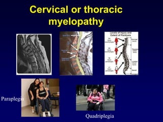 Cervical or thoracic
myelopathy
Paraplegia
Quadriplegia
 