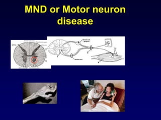MND or Motor neuron
disease
 