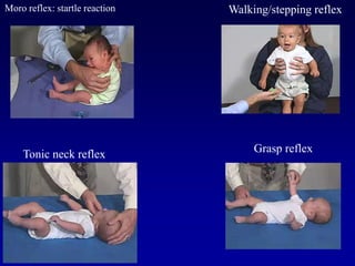 Grasp reflexTonic neck reflex
Walking/stepping reflexMoro reflex: startle reaction
 