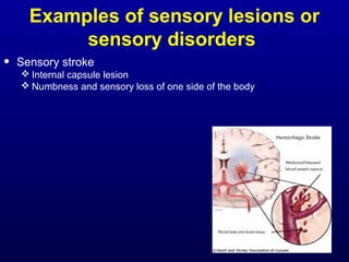 Examples of sensory lesions or
sensory disorders
• Sensory stroke
 Internal capsule lesion
 Numbness and sensory loss of one side of the body
 