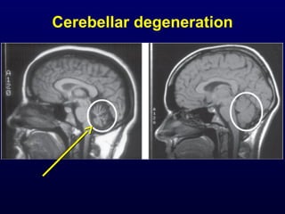 Cerebellar degeneration
 