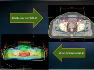 3 Field arrangement (Ph 1)
5 fields arrangement(ph 2)
 