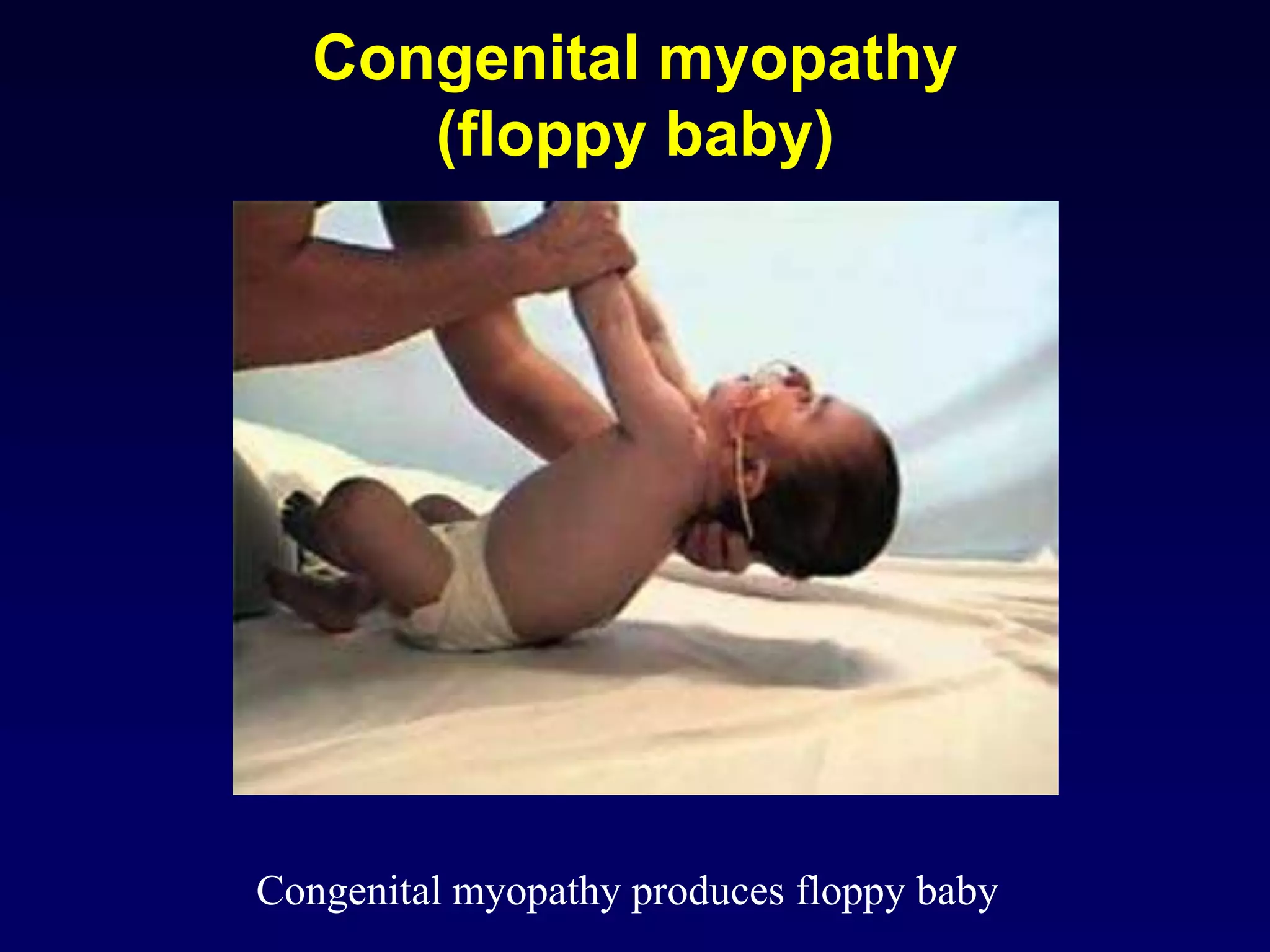 Congenital myopathy
(floppy baby)
Congenital myopathy produces floppy baby
 