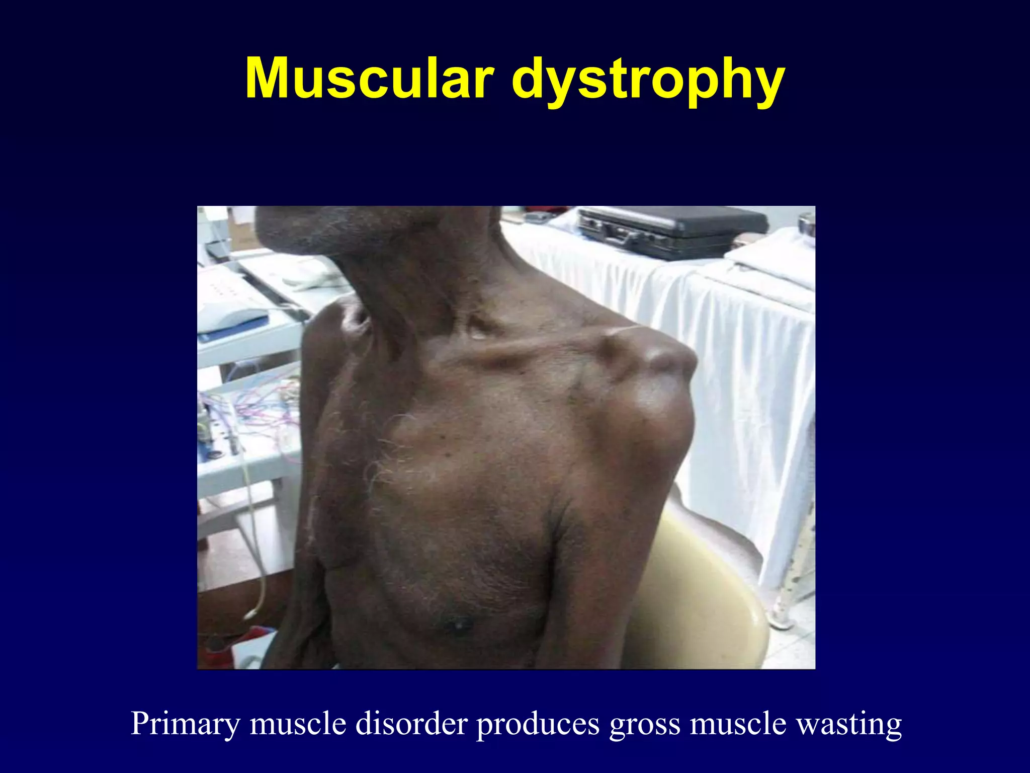Muscular dystrophy
Primary muscle disorder produces gross muscle wasting
 