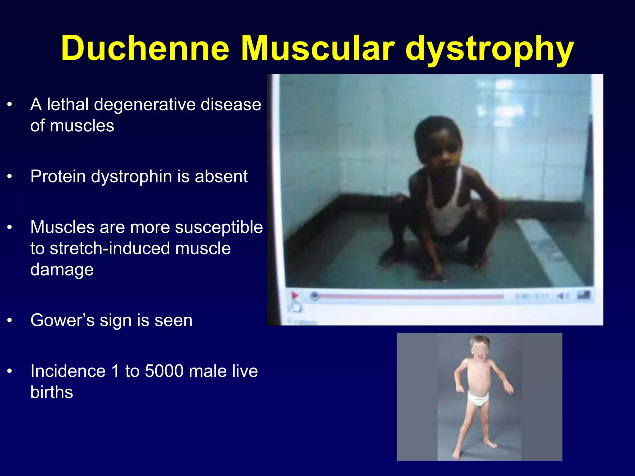 Duchenne Muscular dystrophy
• A lethal degenerative disease
of muscles
• Protein dystrophin is absent
• Muscles are more susceptible
to stretch-induced muscle
damage
• Gower’s sign is seen
• Incidence 1 to 5000 male live
births
 