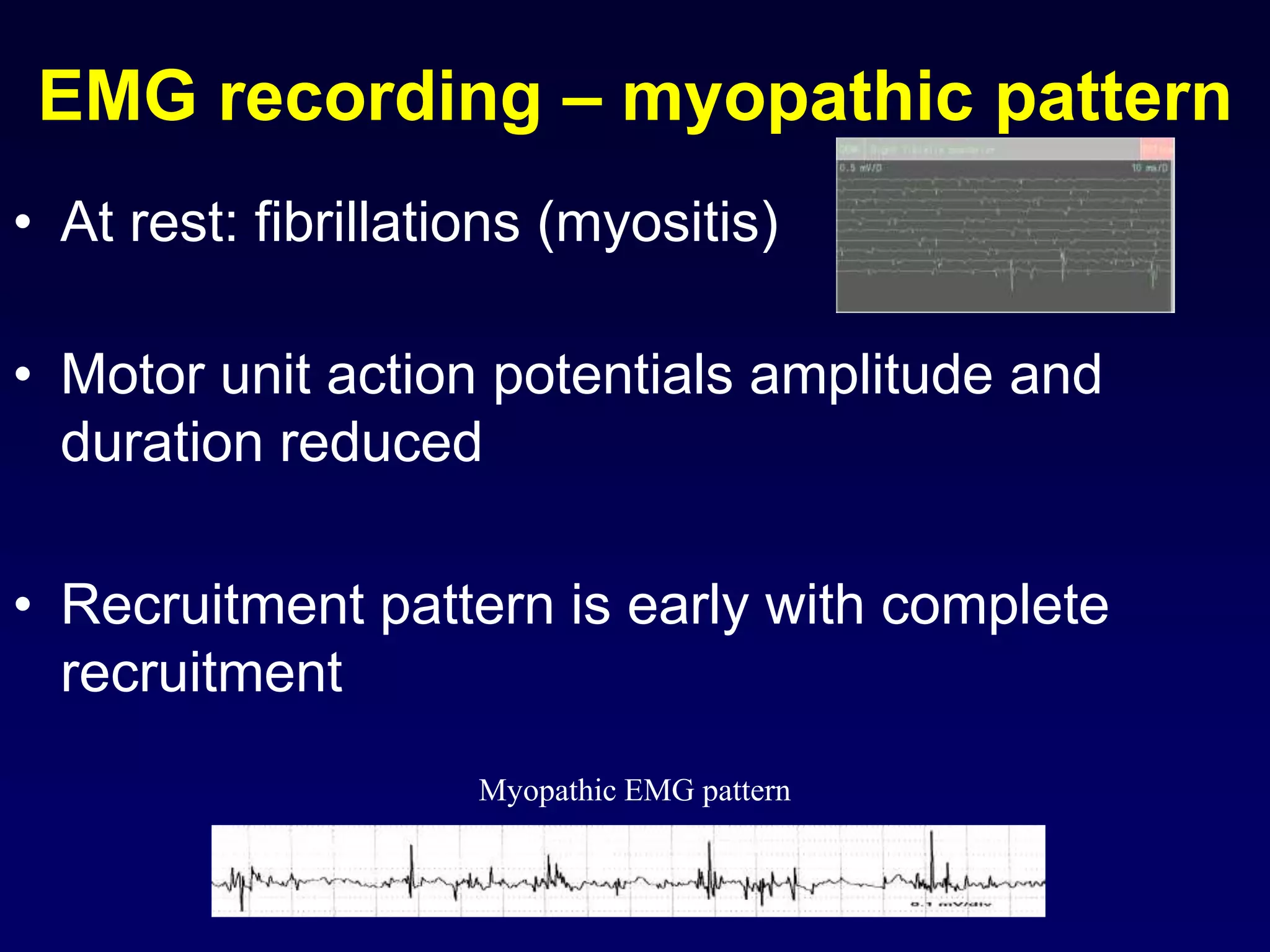 EMG recording – myopathic pattern
• At rest: fibrillations (myositis)
• Motor unit action potentials amplitude and
duration reduced
• Recruitment pattern is early with complete
recruitment
Myopathic EMG pattern
 