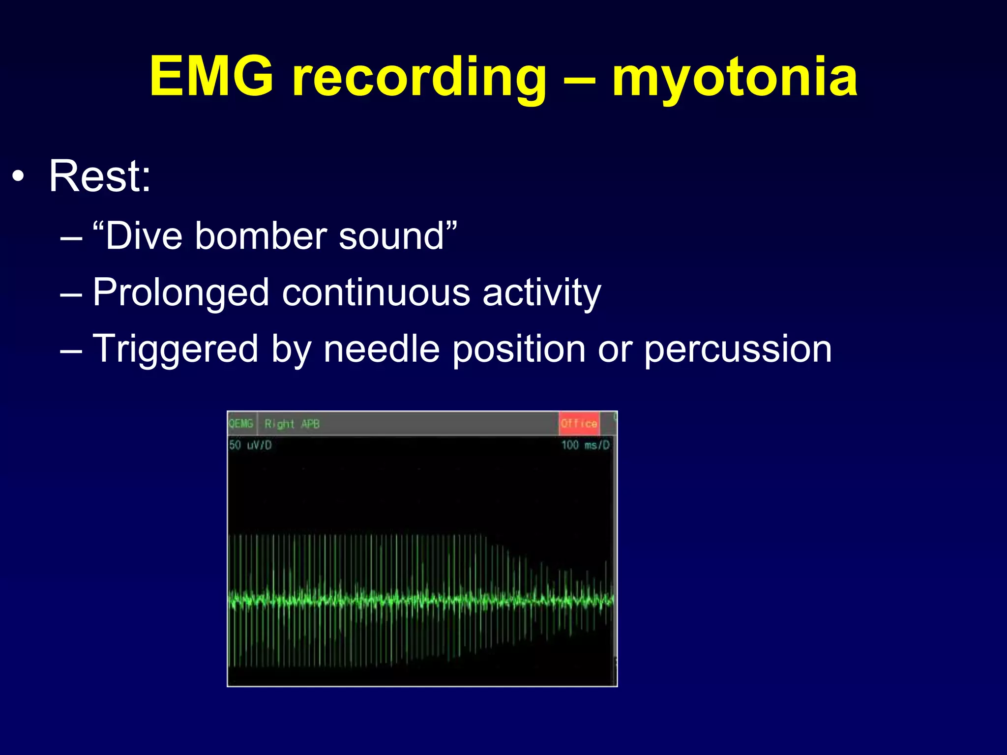 EMG recording – myotonia
• Rest:
– “Dive bomber sound”
– Prolonged continuous activity
– Triggered by needle position or percussion
 