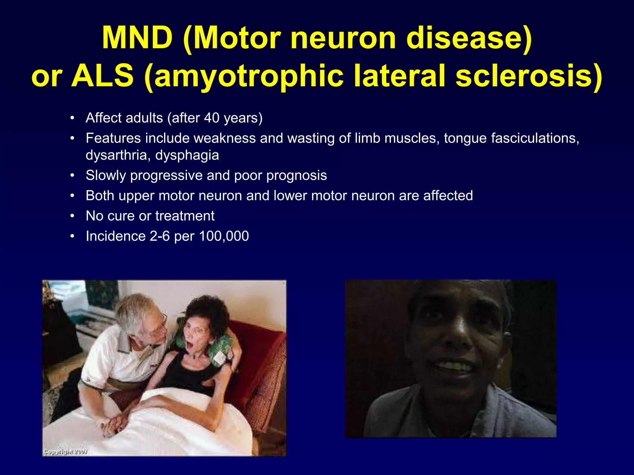 MND (Motor neuron disease)
or ALS (amyotrophic lateral sclerosis)
• Affect adults (after 40 years)
• Features include weakness and wasting of limb muscles, tongue fasciculations,
dysarthria, dysphagia
• Slowly progressive and poor prognosis
• Both upper motor neuron and lower motor neuron are affected
• No cure or treatment
• Incidence 2-6 per 100,000
 