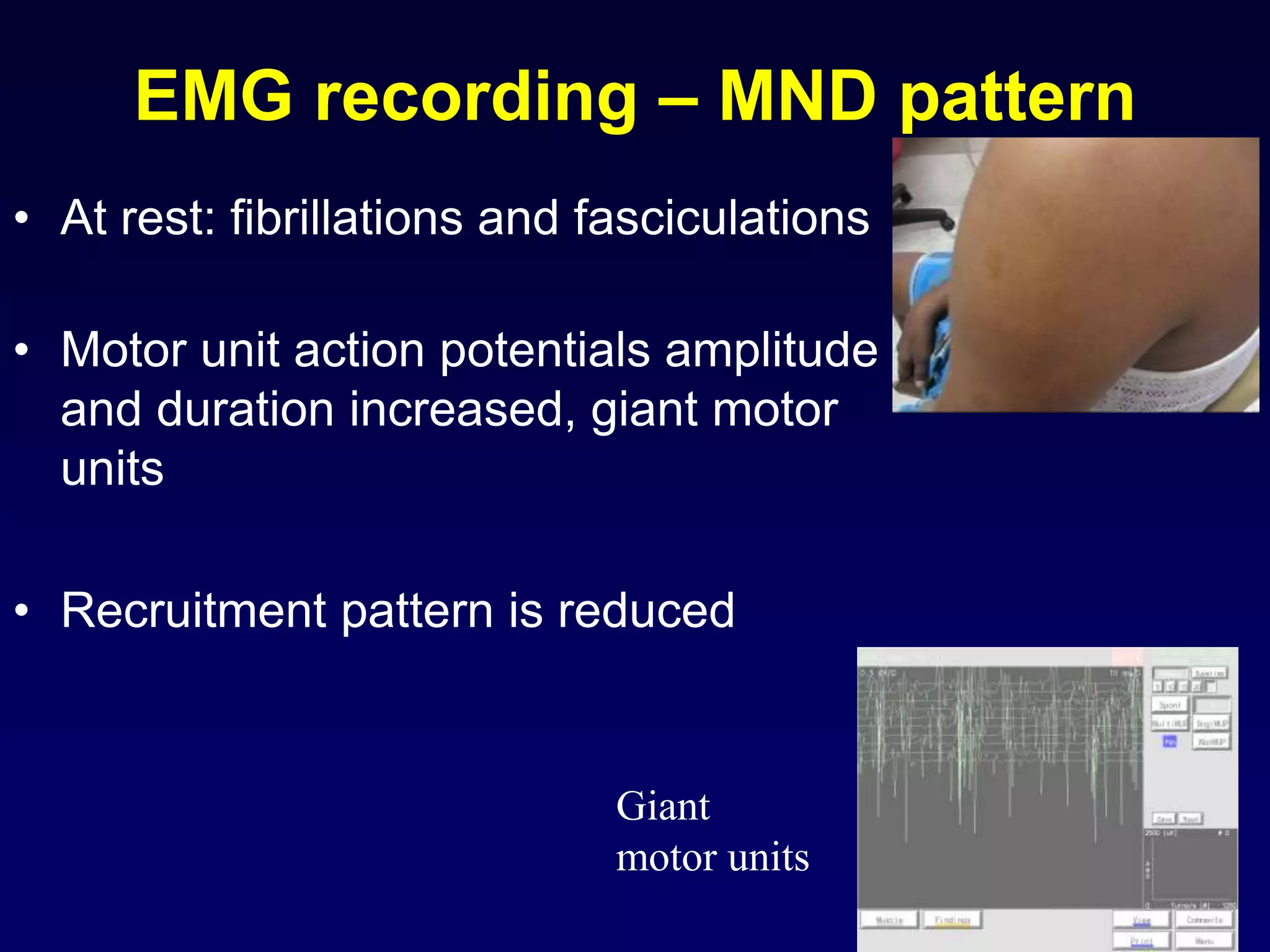 EMG recording – MND pattern
• At rest: fibrillations and fasciculations
• Motor unit action potentials amplitude
and duration increased, giant motor
units
• Recruitment pattern is reduced
Giant
motor units
 