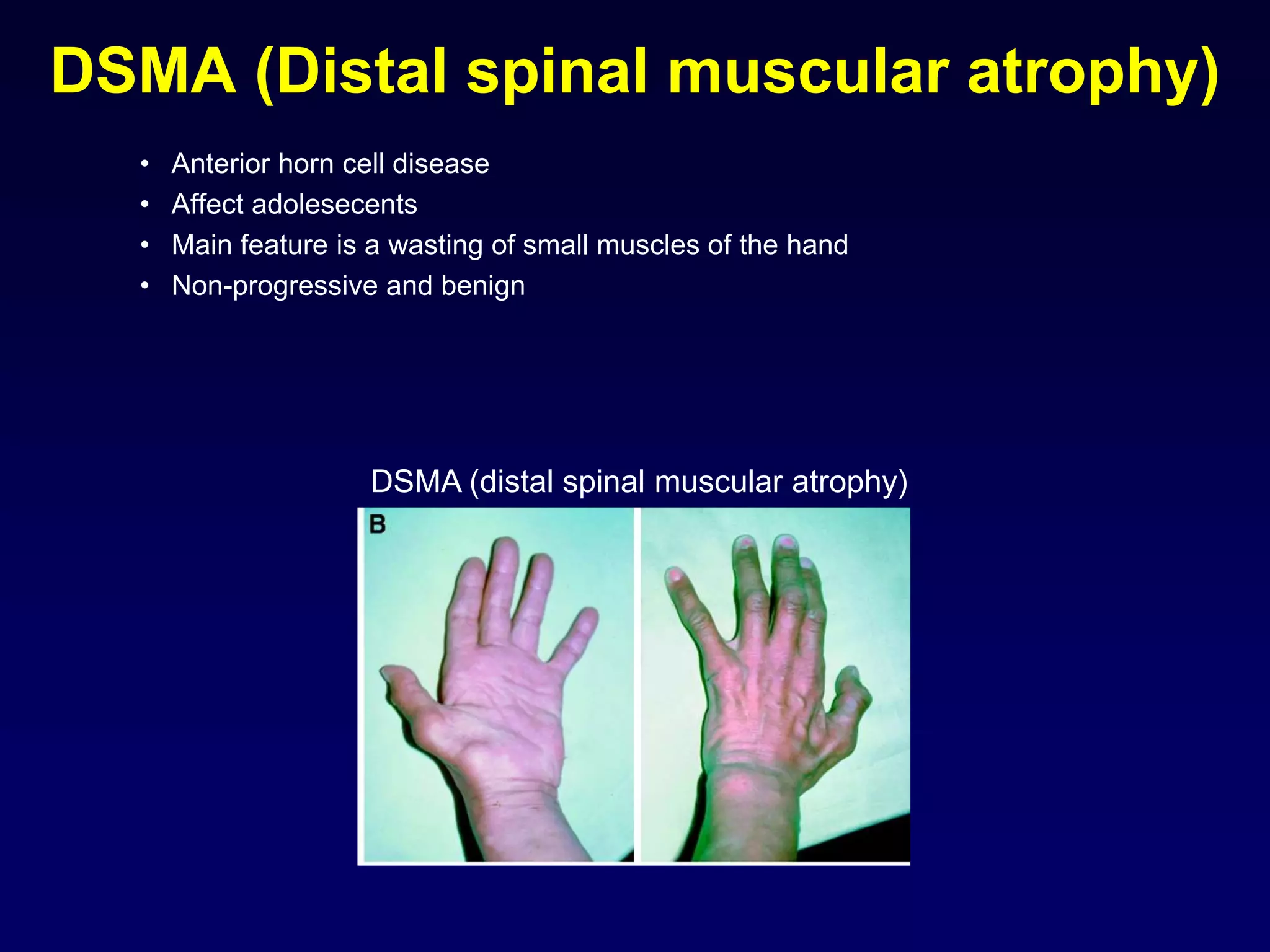 DSMA (Distal spinal muscular atrophy)
• Anterior horn cell disease
• Affect adolesecents
• Main feature is a wasting of small muscles of the hand
• Non-progressive and benign
DSMA (distal spinal muscular atrophy)
 