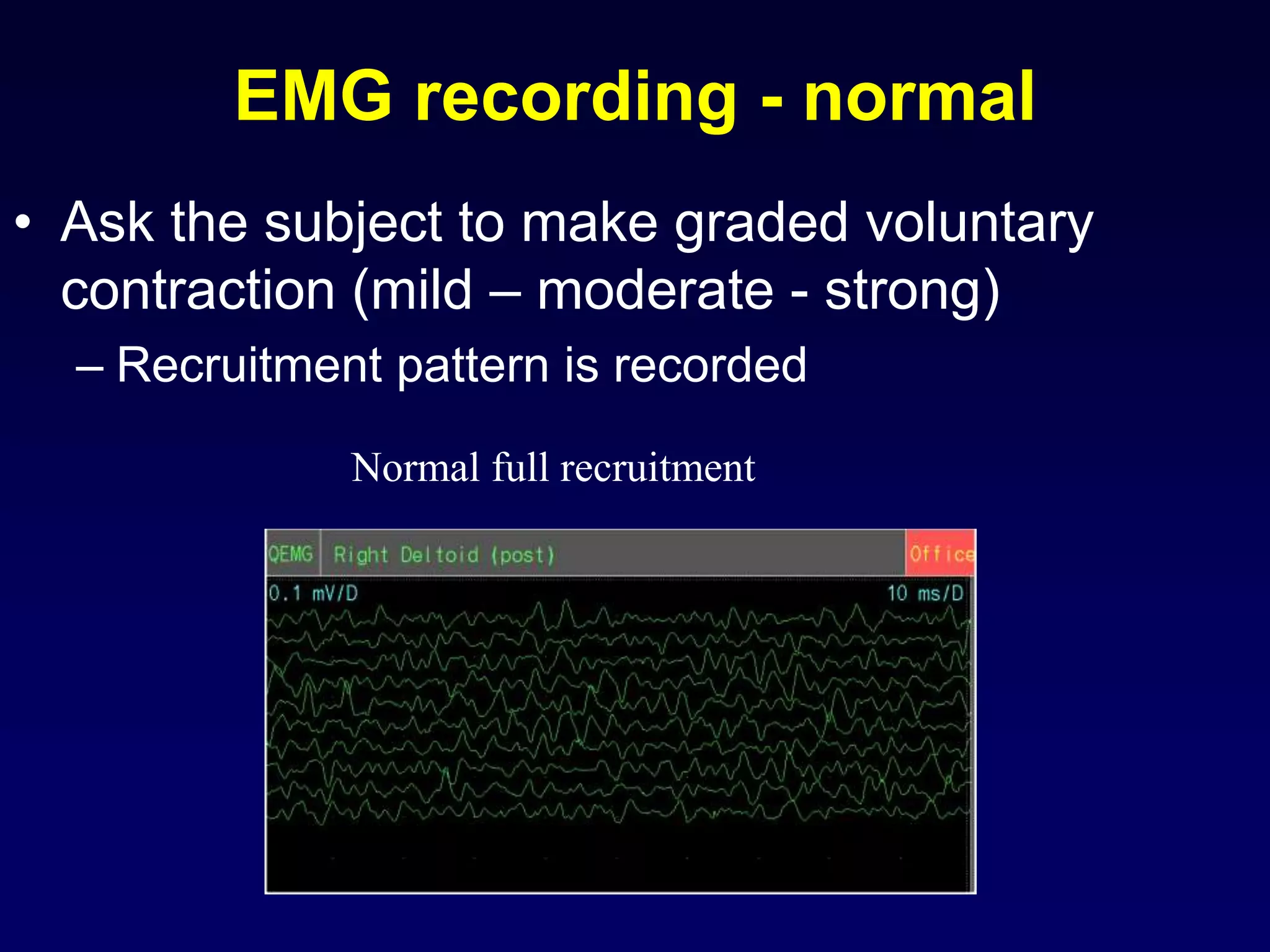 EMG recording - normal
• Ask the subject to make graded voluntary
contraction (mild – moderate - strong)
– Recruitment pattern is recorded
Normal full recruitment
 