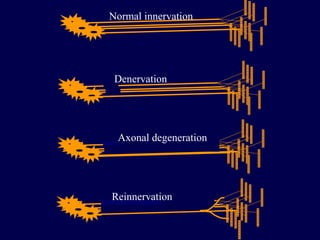 Normal innervation




 Denervation




 Axonal degeneration




Reinnervation
 