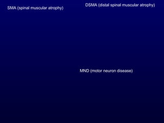 DSMA (distal spinal muscular atrophy)
SMA (spinal muscular atrophy)




                                MND (motor neuron disease)
 