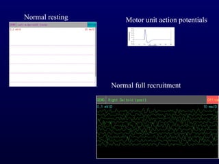 Normal resting       Motor unit action potentials




                 Normal full recruitment
 