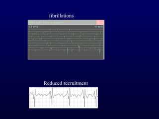 fibrillations




Reduced recruitment
 