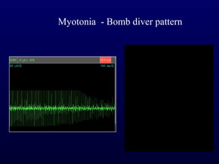 Myotonia - Bomb diver pattern
 