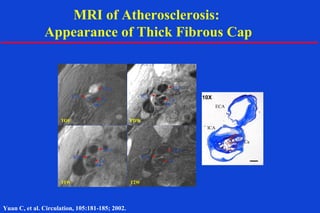 TOF
T2W
PDW
T1W
ICA
ICA
ICA
ICA
ECA
ECAECA
ECA
ECA
ICA
Ca
Ca
Ca
Ca
Ca
10X
MRI of Atherosclerosis:
Appearance of Thick Fibrous Cap
Yuan C, et al. Circulation, 105:181-185; 2002.
 