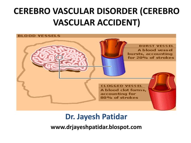 Cva | PDF | Brain and Nervous System Disorders | Diseases and Conditions