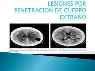 LesionesPor Penetracion De CuerpoExtraño 