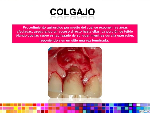 Colgajos y Suturas