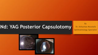 Nd: YAG Posterior Capsulotomy
By
Dr. Alshymaa Moustafa
Ophthalmology Specialist
 