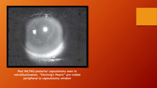 Post Nd:YAG posterior capsulotomy seen in
retroillumination. “Elschnig’s Pearls” are visible
peripheral to capsulotomy window
 
